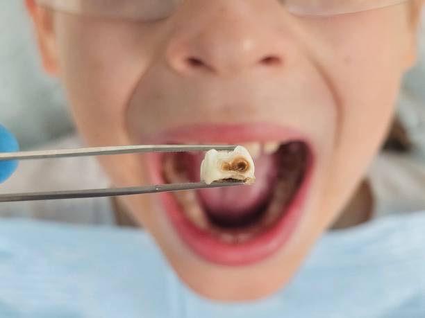 Best Emergency Root Canal Treatment in Little Elm, TX